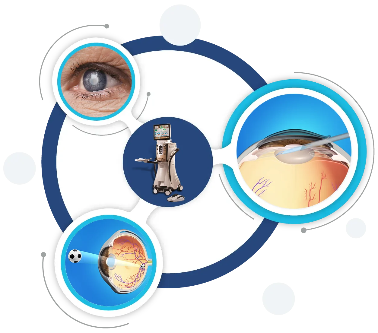 Refractive Eye Surgery