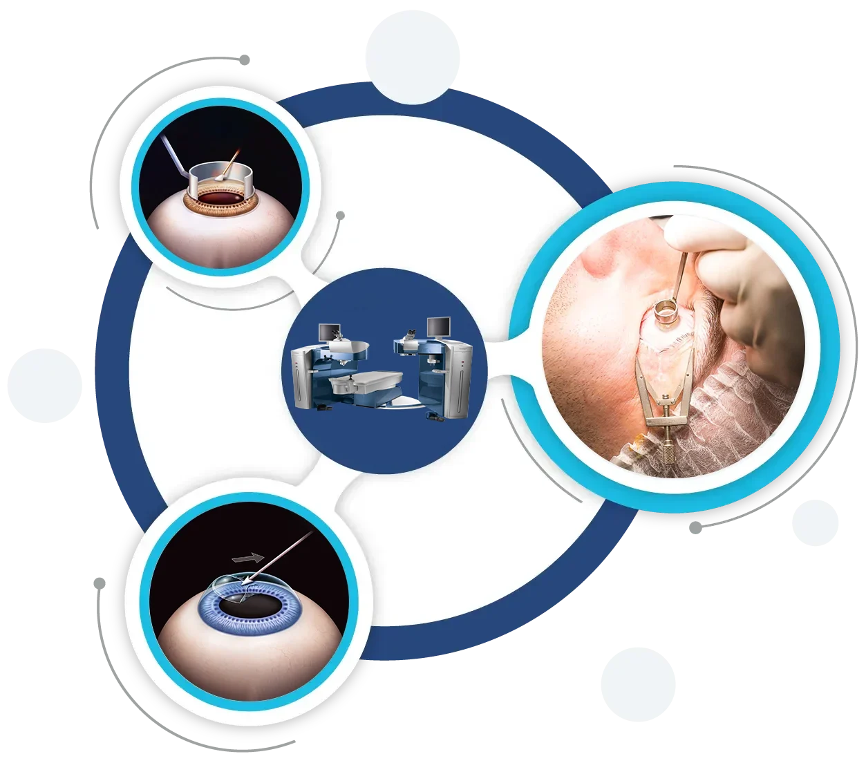 Refractive Eye Surgery