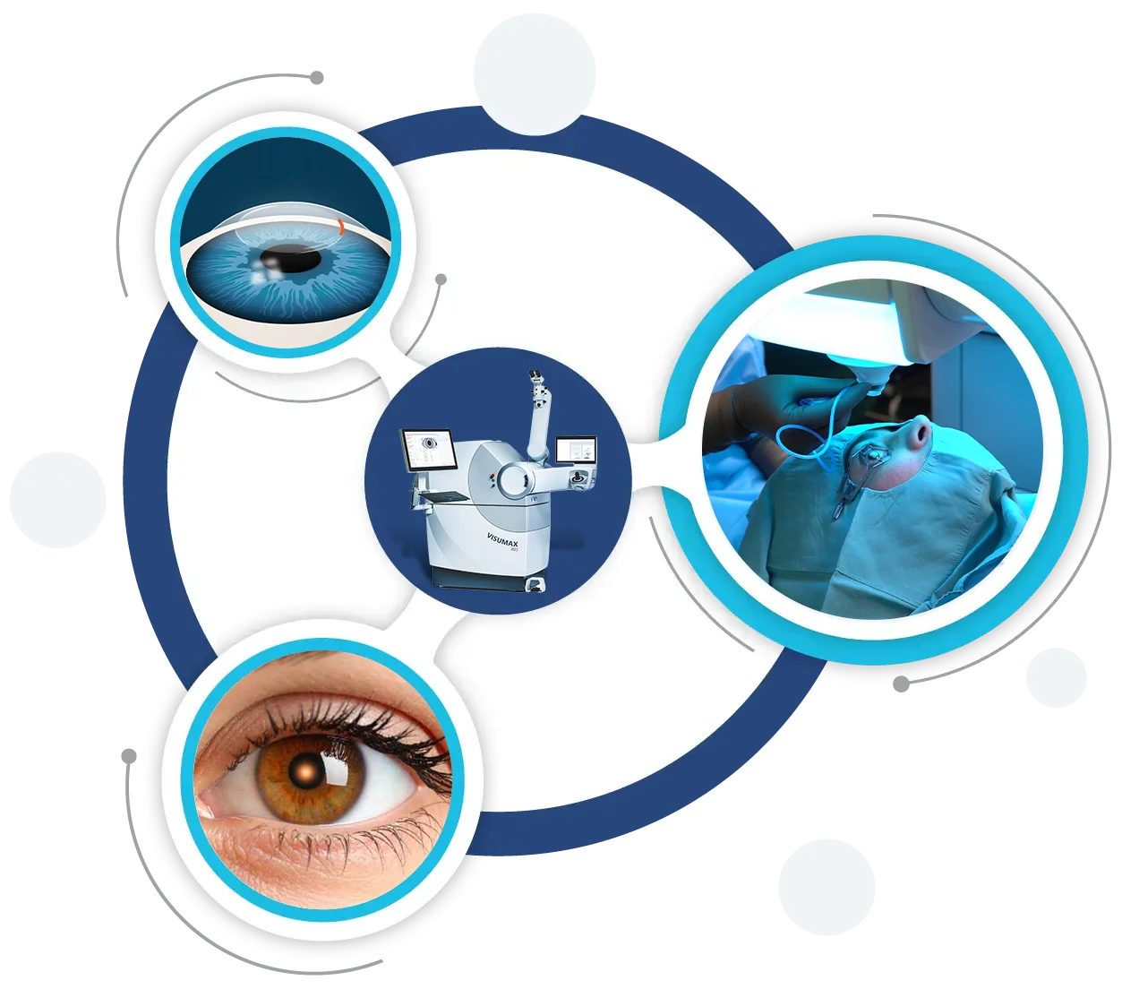 Refractive Eye Surgery