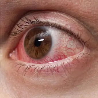 Uveitis Problem