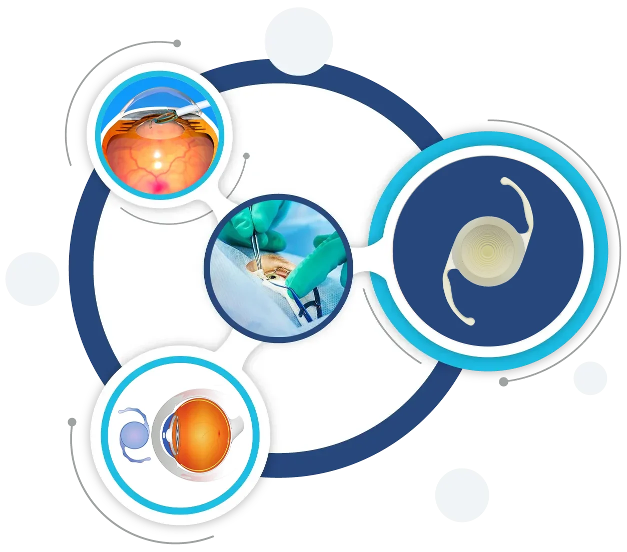 Refractive Eye Surgery